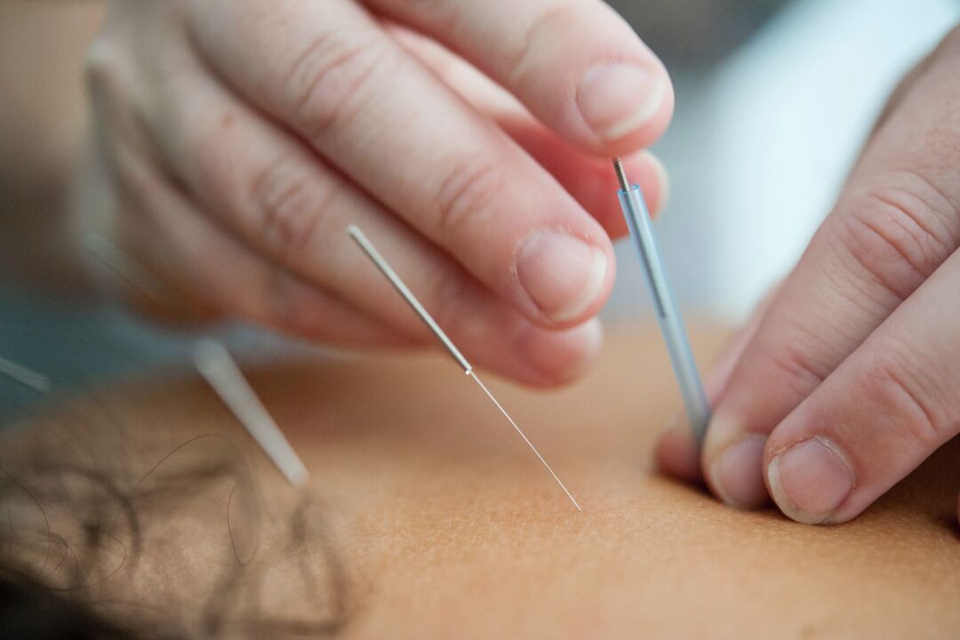 Acupuncture is an inefficient way of ceasing smoking