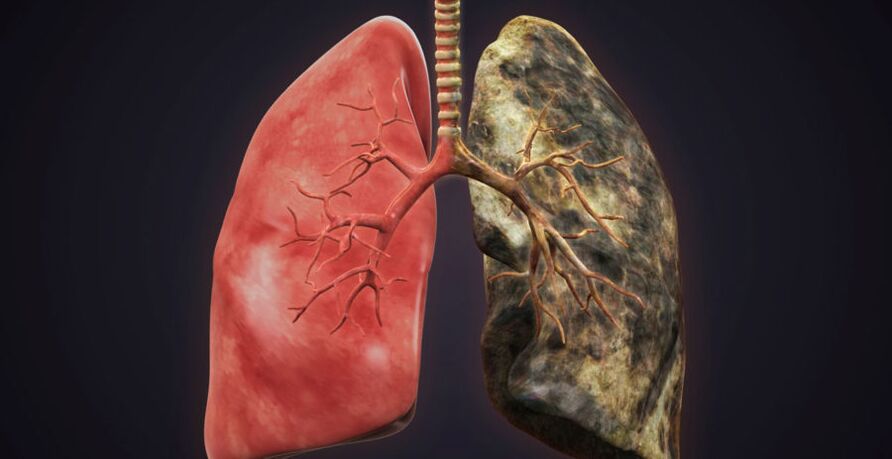 lungs of smokers and quit smoking